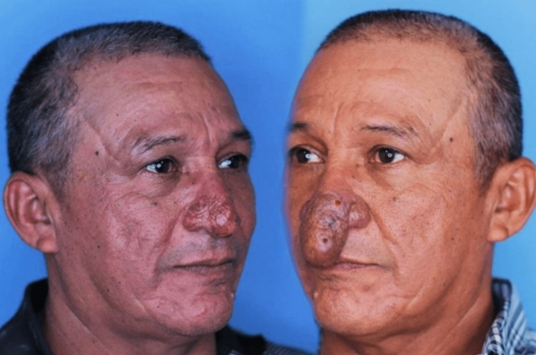 The Astonishing Transformation of Conrado’s Nose